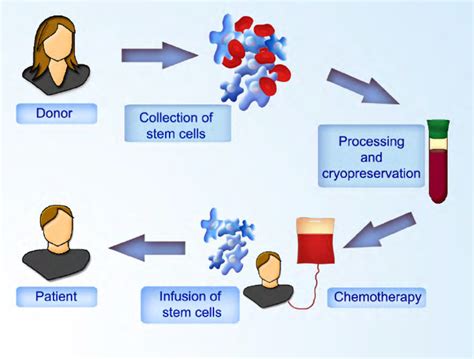 bone marrow transplant pcso|Patient education: Hematopoietic cell transplantation (bone .